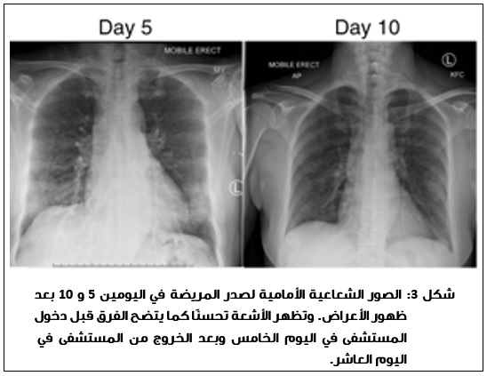  />وتبين مجمل نتائج الدراسة على أهمية رد الفعل المناعي في التخلص من فيروس كورونا، مما يفتح مجالا لدور التطعيمات ضد هذا الفيروس كعلاج وقائي قبل التعرض للعدوى أو كعلاج لحديثي الإصابة والذين لا تبدو عليهم أعراض قوية مثل مضاعفات فشل الجهاز التنفسي أو متلازمة الضائقة التنفسية الحادة أو الحاجة إلى علاج تكميلي بالأكسجين.</p>
<p dir=